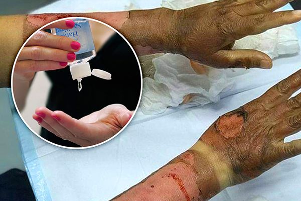 Can Applying Hand Sanitisers Burn You?