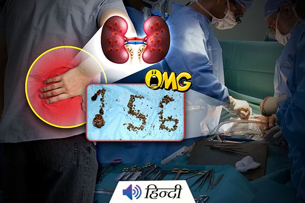 Doctors Remove 156 Kidney Stones From Man