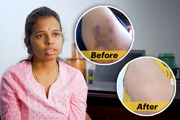 How I Healed My Eczema In Just 3 Months